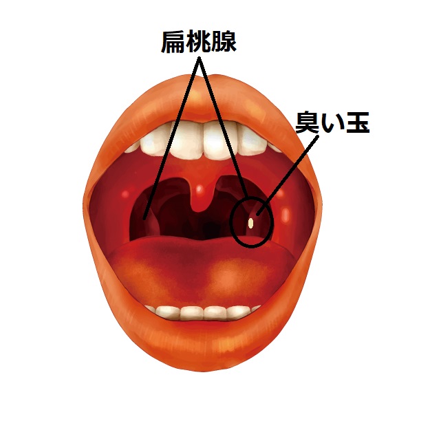 玉 匂い 臭い玉（膿栓）が取れない？ためしてガッテンでやってた臭い玉の原因