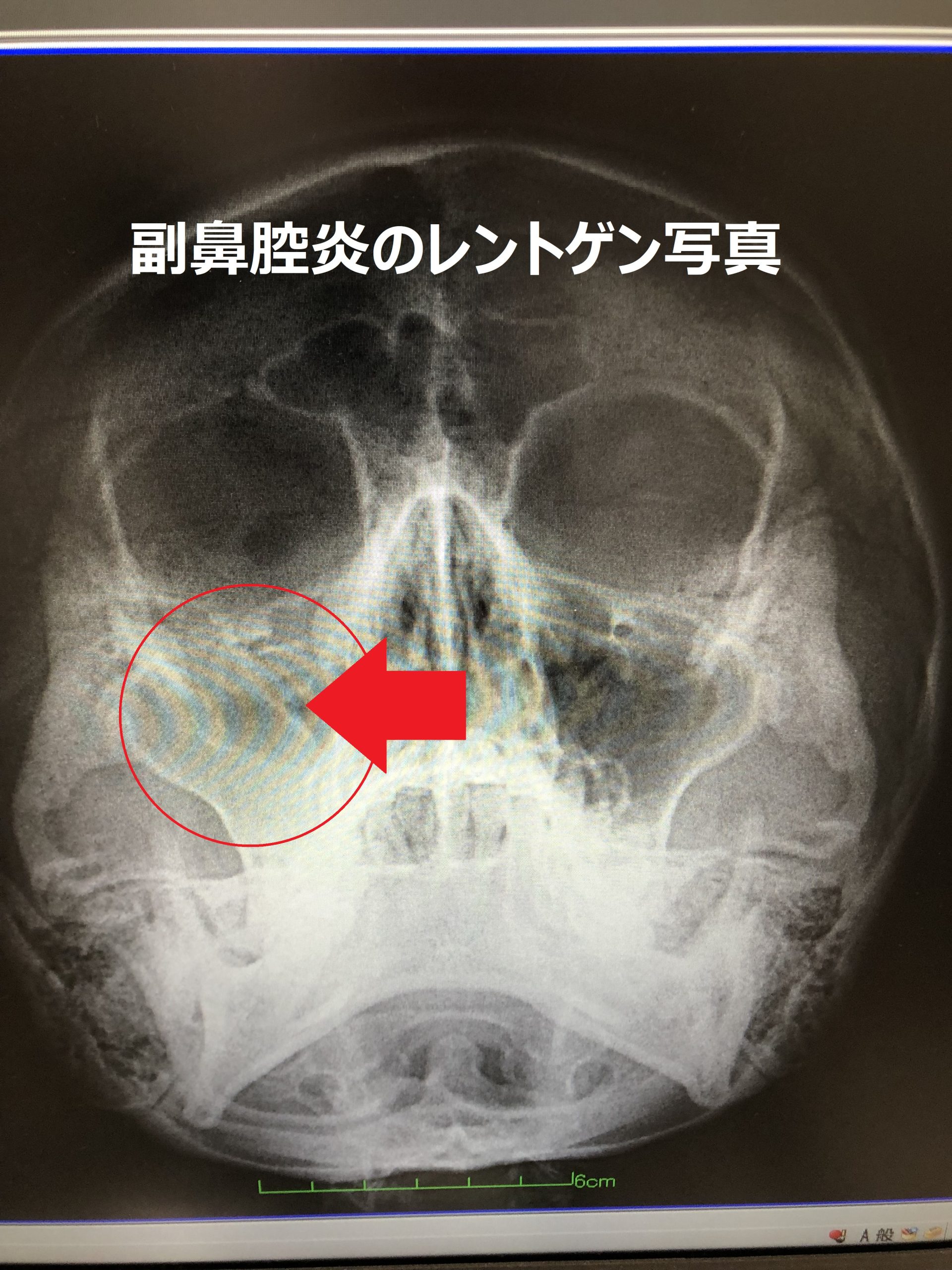 鼻窦炎有哪些症状？鼻炎和鼻窦炎的区别 - 知乎